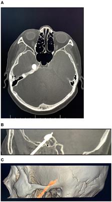 Clinical Efficacy of a Spiral CT-Guided Balloon Compression Day-Surgery Operation for the Treatment of Trigeminal Neuralgia